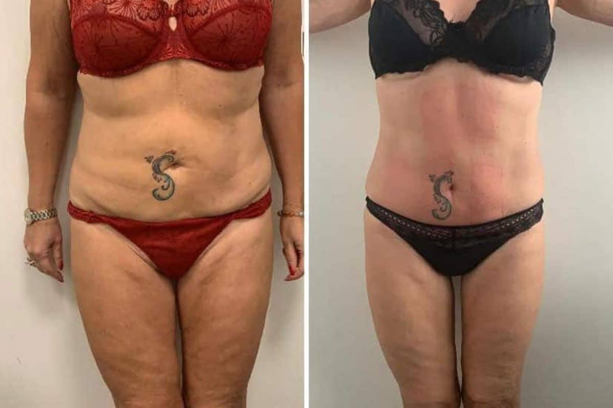 Le soin Cryolipolyse en pratique au centre Astera Aesthetic à Uccle